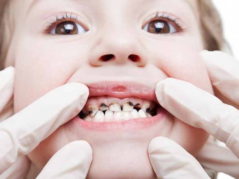صورة من دوتشيه فيلله.. هكذا تحمي طفلك من مرض "الأسنان الطباشيرية"